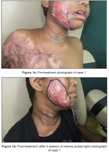 cosmetic plastic surgery in kolkata-2