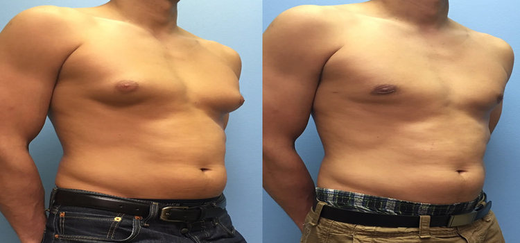 Tips about choosing the right Gynecomastia Surgeon