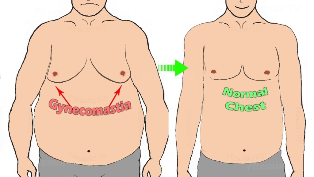 Enlargement of male breast 